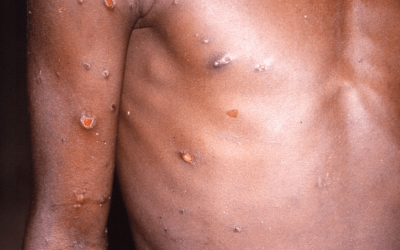 A varíola dos macacos é uma doença infecciosa geralmente leve, e é endêmica em partes da África ocidental e central. (Foto: CDC/Brian J. W. Mahy)